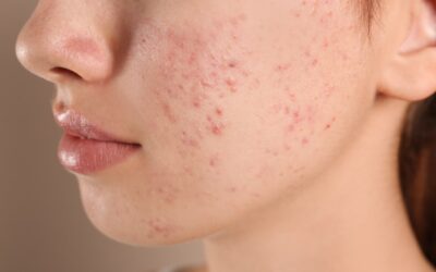 Professional Treatment Options for Sweat-Induced Acne